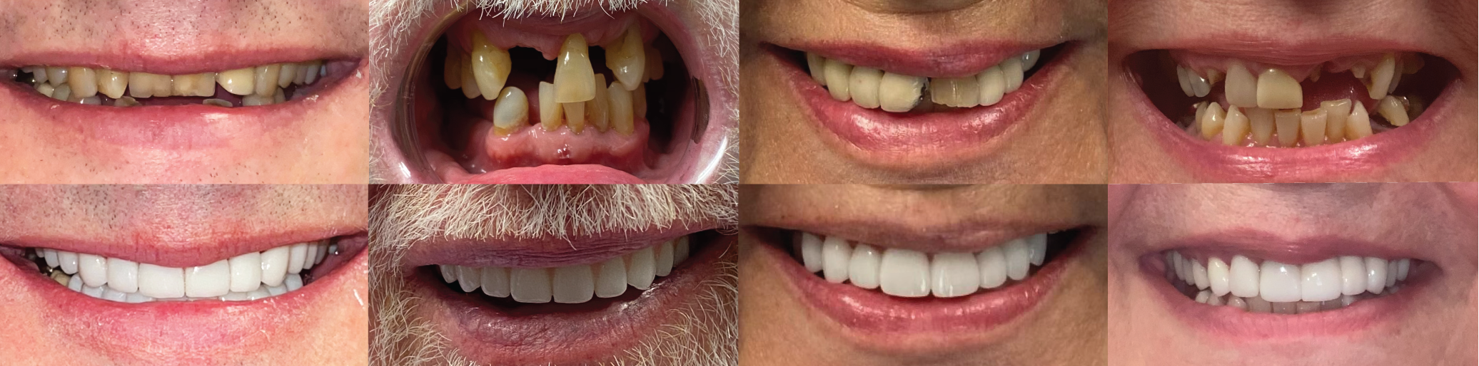 Full mouth dental implants from Troy Family Dental in Troy, Illinois